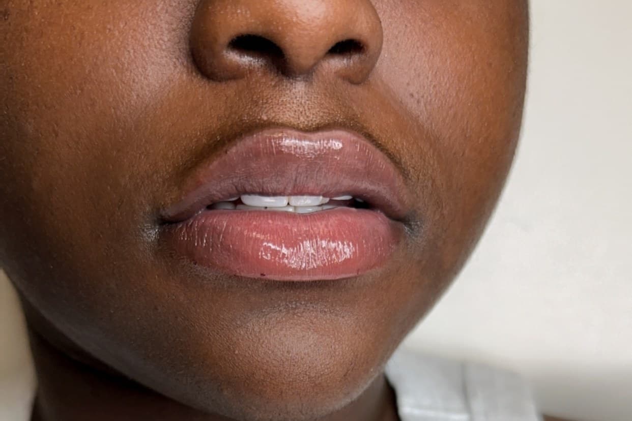 Close up of full, naturally shaped lips after lip filler at Smart Choice
