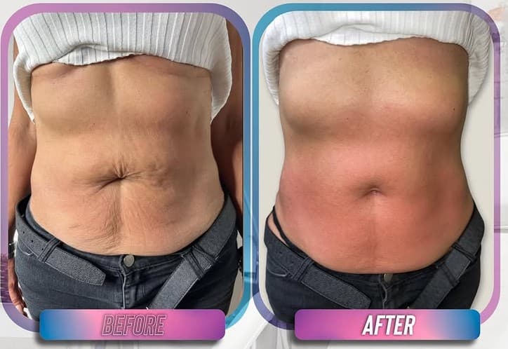Before and after abdomen photos from a Venus Legacy body contouring patient at Smart Choice